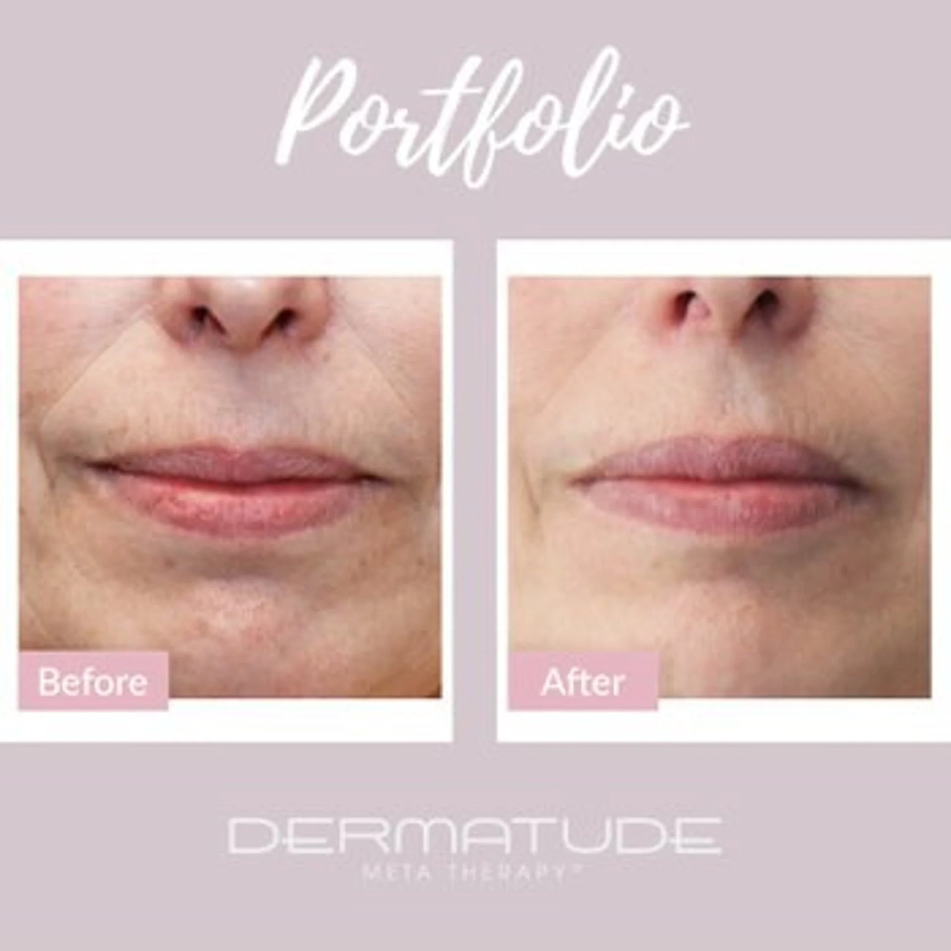 Vorher-Nachher Vergleich Gesichtsbehandlung bei Lena Fuchs